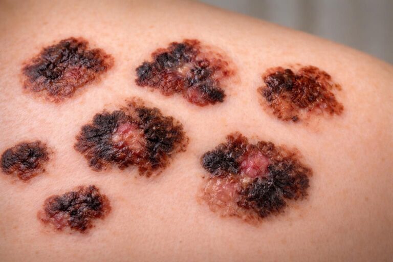 découvrez les signes d’alerte du mélanome de la peau à travers des images explicatives pour une détection précoce et une protection efficace.