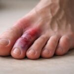 découvrez comment reconnaître les symptômes et les signes d’alerte d’un gros orteil fracturé pour agir rapidement et éviter les complications.