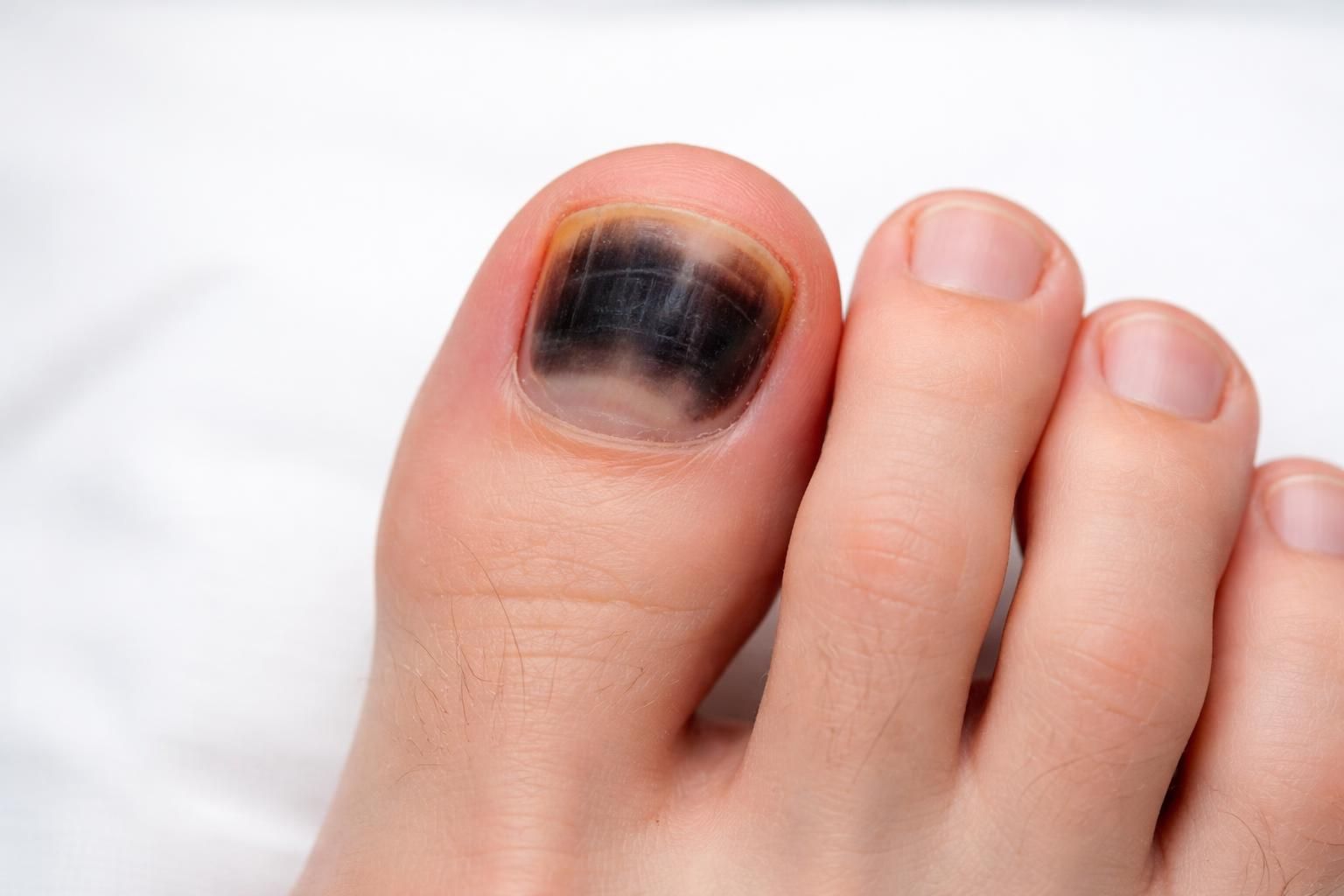 découvrez pourquoi vos ongles de pieds noircis peuvent être un simple hématome ou le signe d’un problème de santé plus grave, et quand consulter un professionnel.